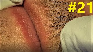 BLACKHEADS EXTRACTIONS on Happy's Upper Lip