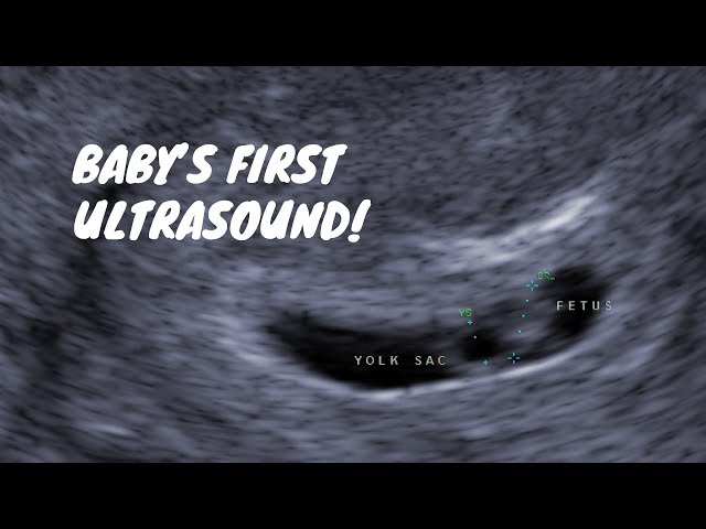 Ultrasound At 6 Weeks All You Need To Know