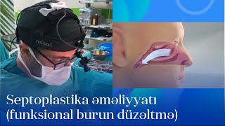 Nazal problemdə funksional burun düzəltmə əməliyyatı | Uzm.Dr.Dilqəm Məmmədov