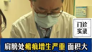 肩膀处瘢痕增生严重！医生给出三种治疗方案 瘢痕增生 疤痕 疤痕增生 医学科普