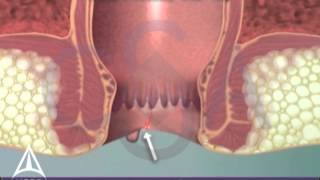 What is an anal fissure? 3D animation
