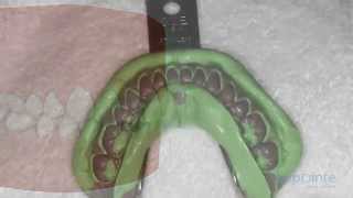 Veneers - Lapointe dental centres