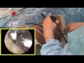 hip arthroscopy procedure by dr. patrick jost