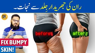 Cellulite Ka Ilaj | Uneven, Dimpled, Bumpy Skin on Legs, Thighs, Butt | Dr. Ibrahim