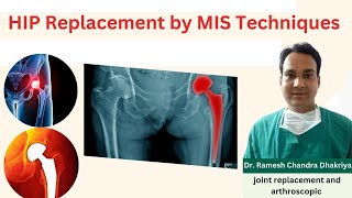 HIP Replacement by MIS Techniques | Difference between Conventional and MIS Technique.