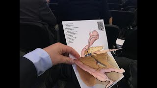 Lap-CME right hemicolectomy step-by-step using critical view concept