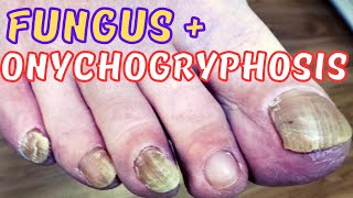 Thick fungal toenails treatment + Ram`s Horn (onychogryphosis)