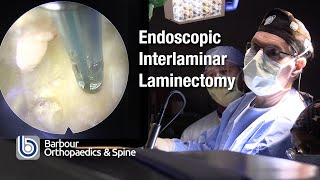 Endoscopic Interlaminar Laminectomy - Douglas Linville, M.D.