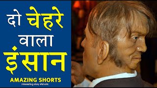 दुनिया का पहला दो चेहरे वाला इंसान 😲 Amazing Facts #shorts