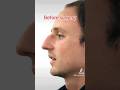 Incredible Male Rhinoplasty Results in only 6 weeks! #shorts #rhinoplasty