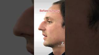 Incredible Male Rhinoplasty Results in only 6 weeks! #shorts #rhinoplasty