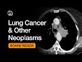 Lung Cancer & Other Neoplasms | Chest Radiology Board Review