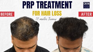PRP hair loss treatment before and after results