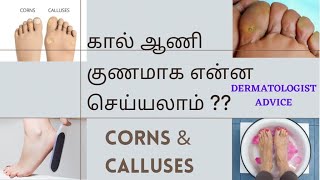 கால் ஆணி குணமாக என்ன செய்ய வேண்டும்?|Corns \u0026 Calluses|Dermatologist advice|Dr.Santhiya Niranjan