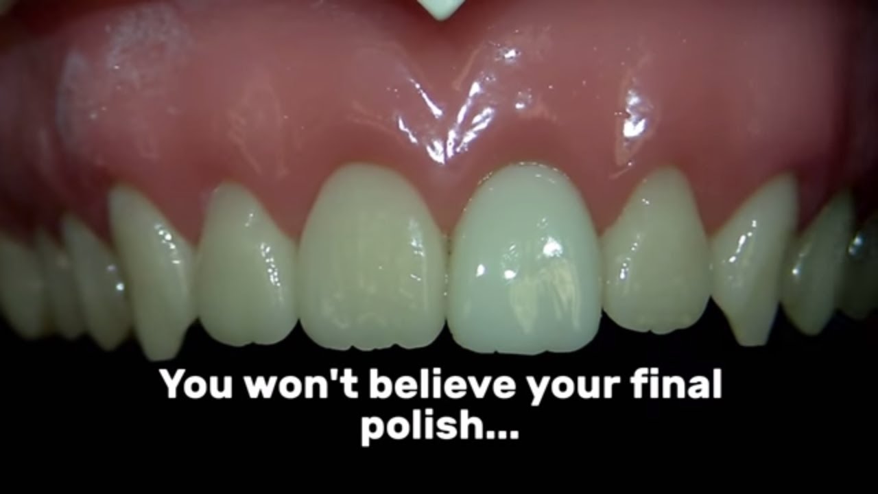 Best Final Polishing Combo For Composite Restorations | Cosmedent - YouTube