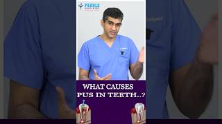 What causes pus in teeth..? - Pearls Dentistry - Dr.Arunkumar