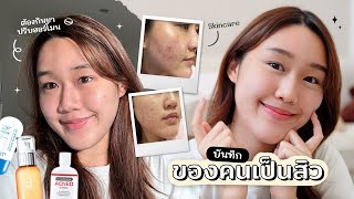 บันทึกของคนเป็นสิว: หน้าไม่เคยเรียบ🥲 รักษาจนหน้าใส กินยา, Skincare โนสปอน!! Peanut Butter