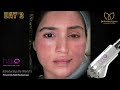 fabulous results halo laser treatment review result after 10 days