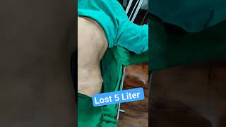 Lose 5 Liter Fat in 1 Hour #abdomenliposuction #shorts #shortvideo