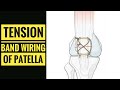 Tension Band Wiring Patella