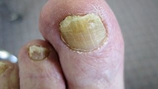 DermTV - How To Treat Toenail Fungus [DermTV.com Epi #131]