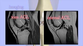 ACL Tears Diagnosis