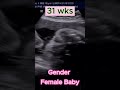 baby gender girl at 31wks and 35wks pregnancy ultrasound pregnancy babygirl gender baby