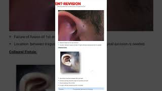 #mbbs #otolaryngology Anomoly of external ear