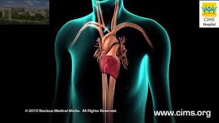 Catheter Ablation - CIMS Hospital