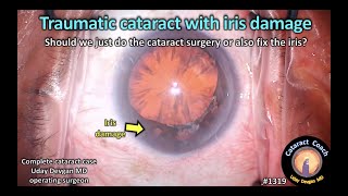 CataractCoach 1319: traumatic cataract with iris damage