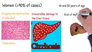 Primary biliary cirrhosis;  Primary biliary cholangitis. Simply Explained