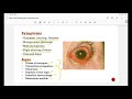 bacterial conjunctivitis ophthalmology types signs and symptoms treatment