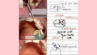 Locating CANAL ORIFICES was never this EASY!! Mandibular and Maxillary first Molar!!