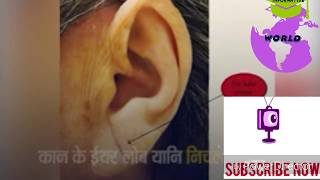 A Viral Video Claims Wrinkle On Ear Lobe Indicate Heart Disease | ABP News