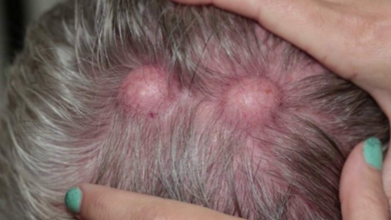 Pimplelike Bumps On The Scalp