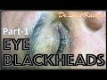 OLD EYE BLACKHEADS PART-1 By Dr.Lalit Kasana