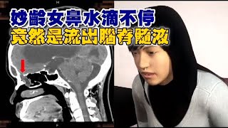 妙齡女鼻水直直流　竟是腦脊髓液外漏 | 台灣蘋果日報