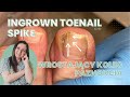 Ingrown teonail spike / Wrastający kolec paznokcia