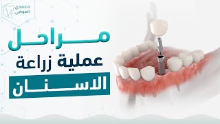 مراحل عملية زراعة الأسنان