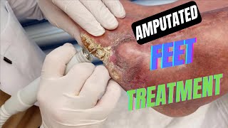 Removing Extremely Massive Heel Callus - Bones Under Pressure - Full Treatment Part 1🦶