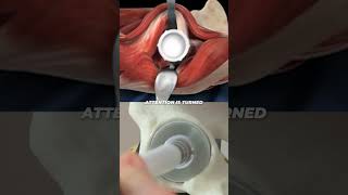 Direct Anterior Approach Hip Replacement