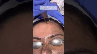 Hollywood Laser Peel Treatment #shorts