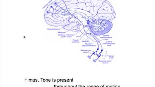 Extrapyramidal neuron lesion---Rigidity(Spasticity VS Rigidity)