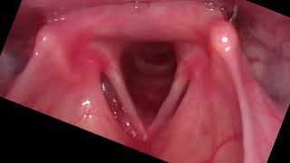 Vocal cord motion during breathing