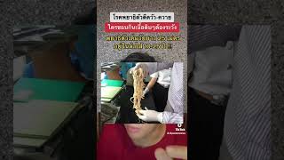 โรคพยาธิตัวตืดวัว-ควาย ใครชอบกินเนื้อดิบๆต้องระวัง !!!