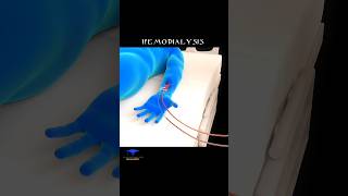 Artificial Kidney (Hemodialysis) Animated video ' #shorts