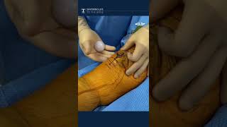 Kneecap [patella] button loosens after total #kneereplacement #kneeinjury #fracture