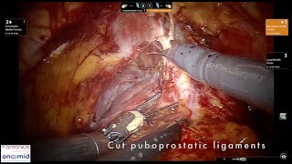 Robot-Assisted Radical Prostatectomy / Robot-geassisteerde Radicale Prostatectomie (RALP) - 2021