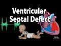 Ventricular Septal Defect, Animation