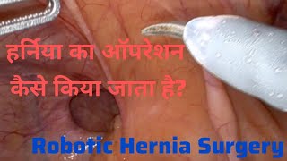 How Hernia Surgery is done? हर्निया का ऑपरेशन कैसे किया जाता है?